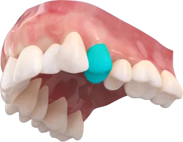 День Aligner