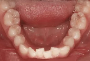 Интраоральные фотографии