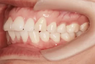 Интраоральные фотографии