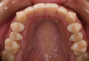 Интраоральные фотографии